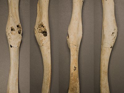 Multiple views of the young teen's right humerus arm bone that runs from the shoulder to the elbow show where the tumor left its mark. 